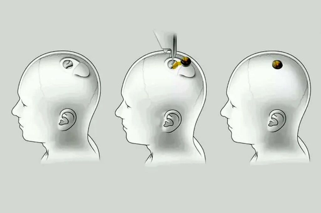 ایلان ماسک نورالینک